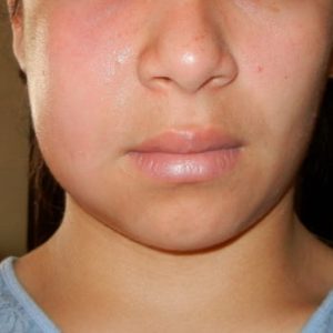abscess-facial-swelling