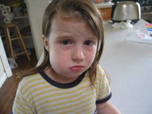abscess-facial-swelling-girl