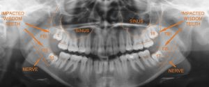 opg-impacted-wisdom-teeth-structures