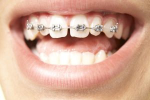 top-braces-600x400